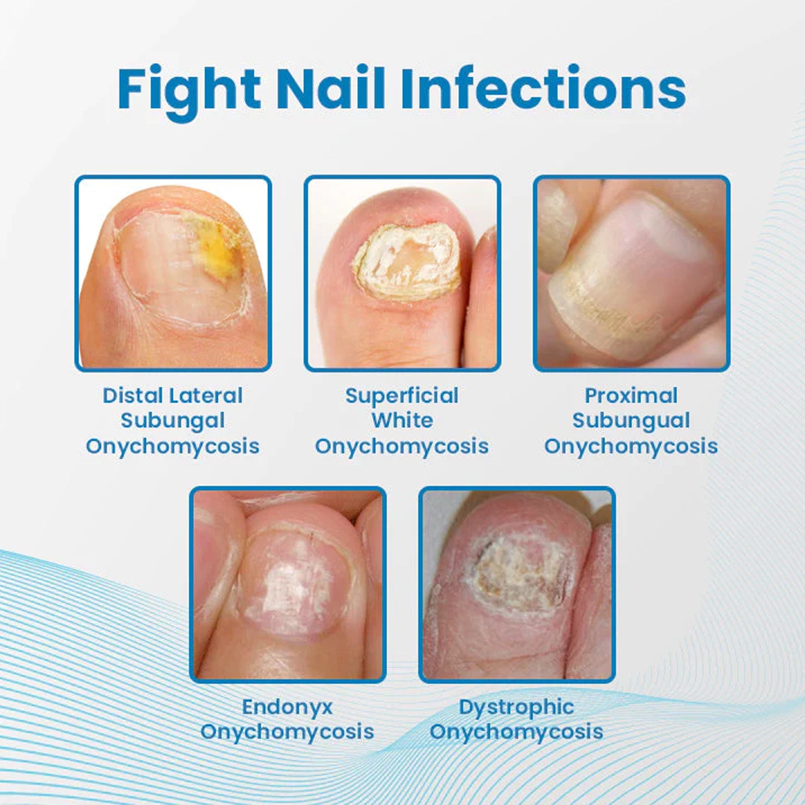 Anti-Paronychia Nail Repairing Gel, Repair Encased Rotten Nails Soft Nails Thickening Pain Relief Cleansing Care