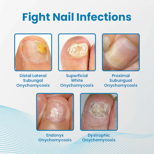 Anti-Paronychia Nail Repairing Gel, Repair Encased Rotten Nails Soft Nails Thickening Pain Relief Cleansing Care