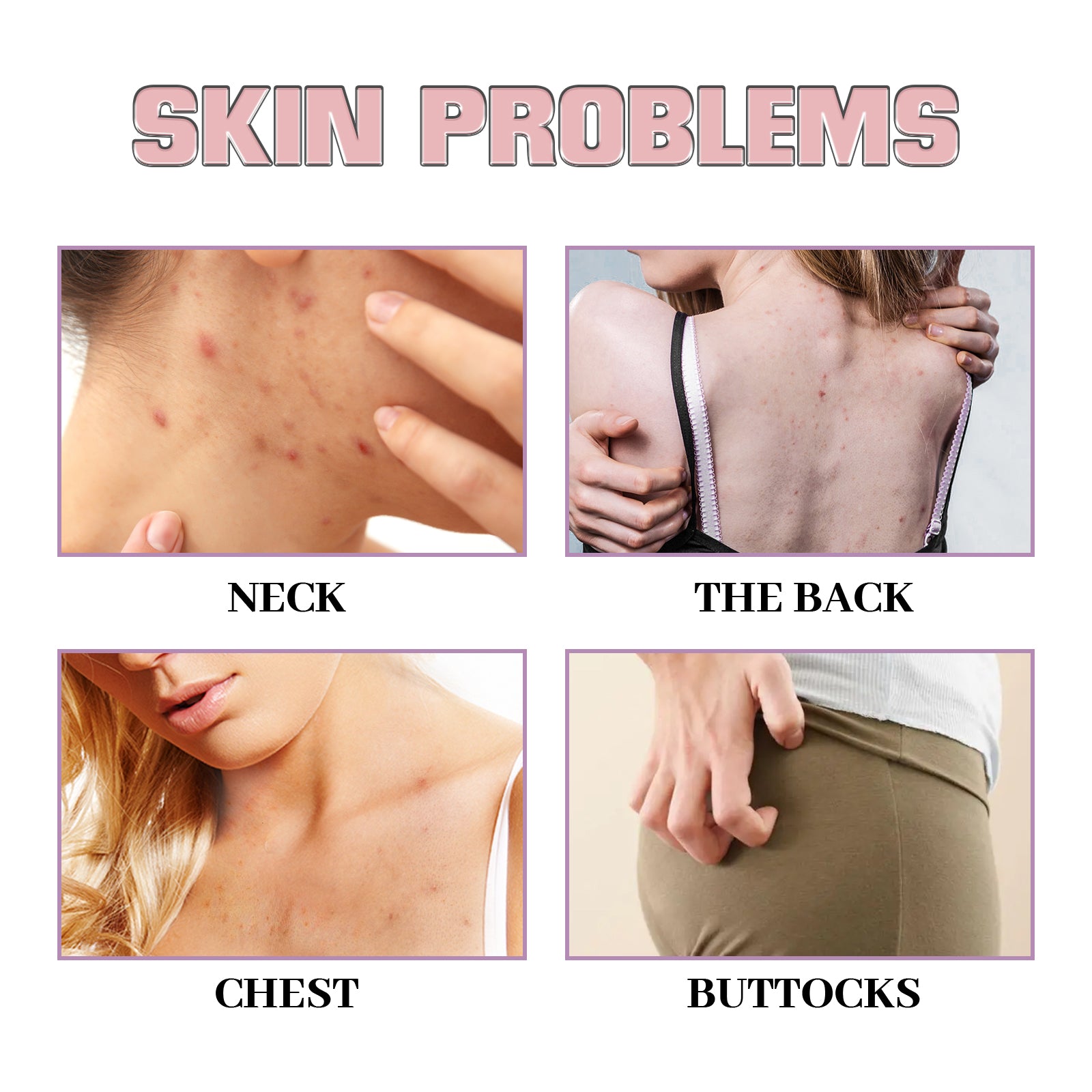 Acne Acne Ball, And Cleansing Skin Chest Back Acne Closing Skin Care