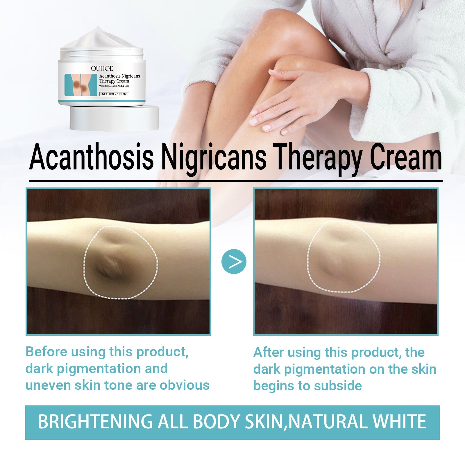 Acanthosis Nigricans Therapy Cream, Repair Dull Skin Lightening Joint Black Moisturizing Whitening Skin Care Cream