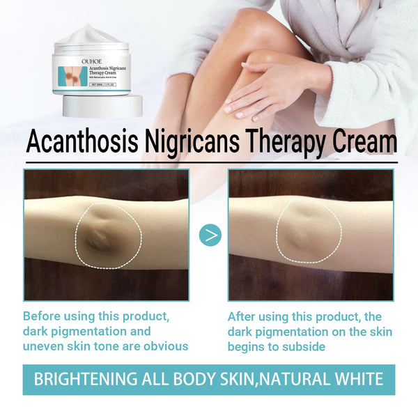 Acanthosis Nigricans Therapy Cream, Repair Dull Skin Lightening Joint Black Moisturizing Whitening Skin Care Cream
