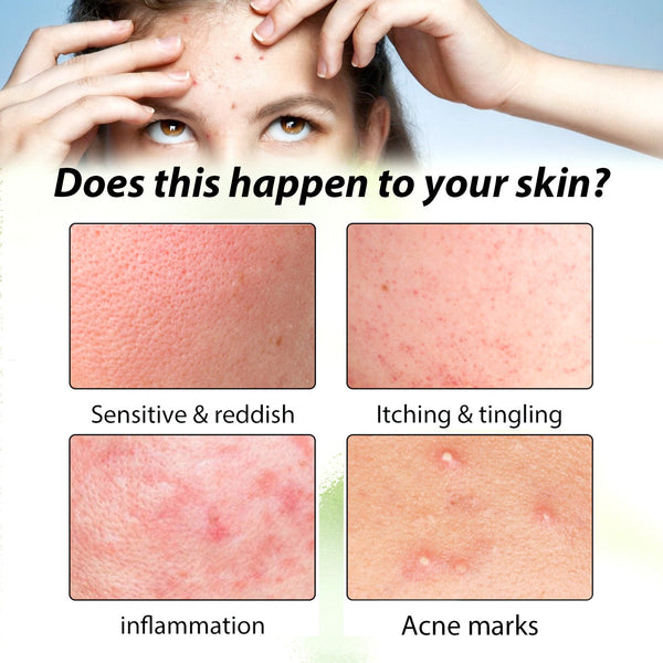 Herbal Acne Serum, Reduce Acne Pimples With A Comprehensive Moisturizing Moisturizer