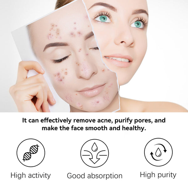 Herbal Acne Serum, Reduce Acne Pimples With A Comprehensive Moisturizing Moisturizer