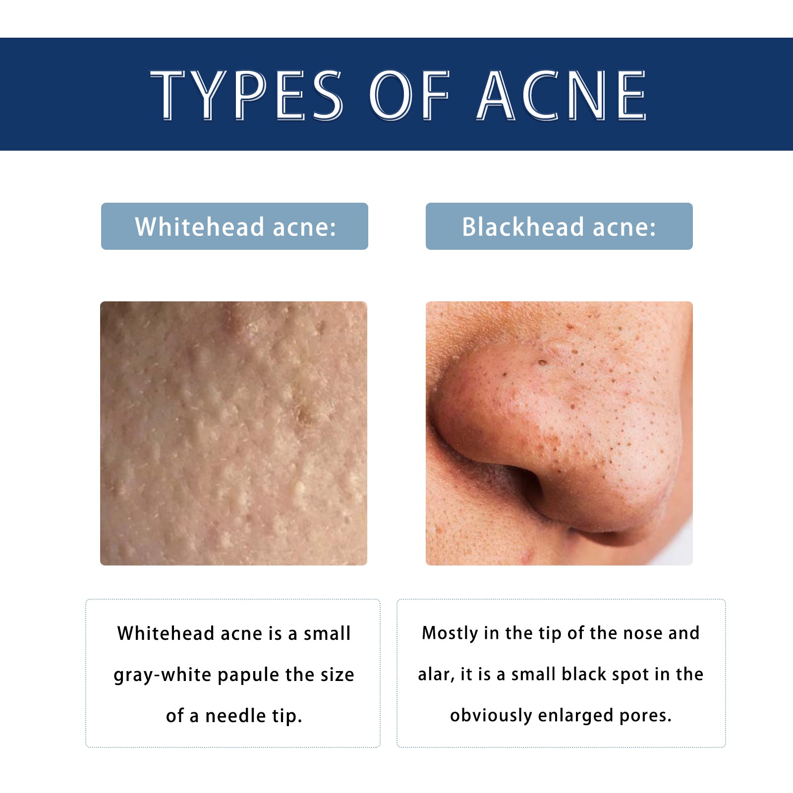 Anti-Pimple Drying Lotion, Facial Cleansing And Repair Lighten Acne Marks And Pits, Close Your Mouth And Mild Skin Cream