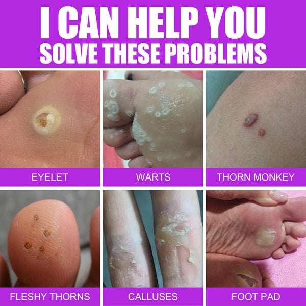 Remove Chicken Eye Lotion Extra Clear Remove Corns Skin Care Chicken Calluses Foot Pad Gram Warts