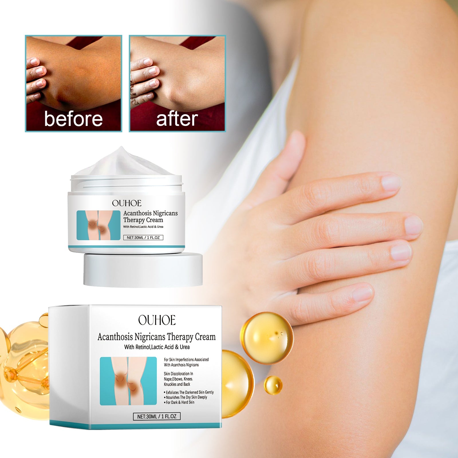 Acanthosis Nigricans Therapy Cream, Repair Dull Skin Lightening Joint Black Moisturizing Whitening Skin Care Cream