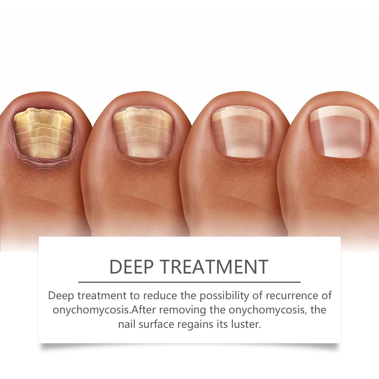 Eohoe Nail Care Instrument, Gentle Clean Nails Repair Hand, Foot And Finger Edge Rotten Nail Care Instrument