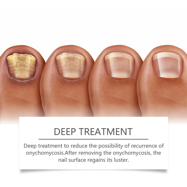 Eohoe Nail Care Instrument, Gentle Clean Nails Repair Hand, Foot And Finger Edge Rotten Nail Care Instrument