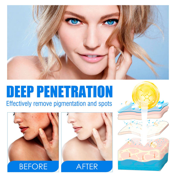 Blemish Cream, Whitening Skin Reduce Melanin Melasma Stains And Hydrating Cream