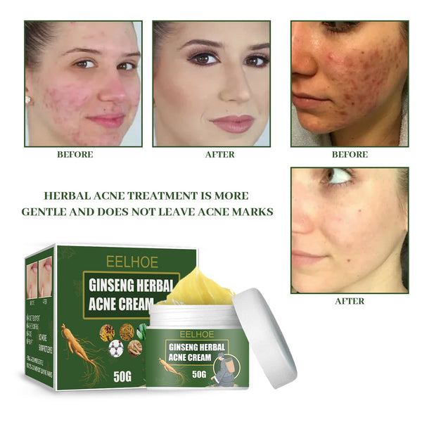 Herbal Acne-Removing Cream Anti-acne-Removing Cream Moisturizing Cleansing Cream Water Oil Balance Anti-acne-Removing Cream