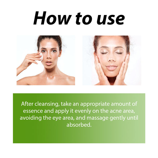 Herbal Acne Serum, Reduce Acne Pimples With A Comprehensive Moisturizing Moisturizer