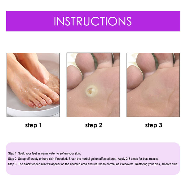 Remove Chicken Eye Lotion Extra Clear Remove Corns Skin Care Chicken Calluses Foot Pad Gram Warts