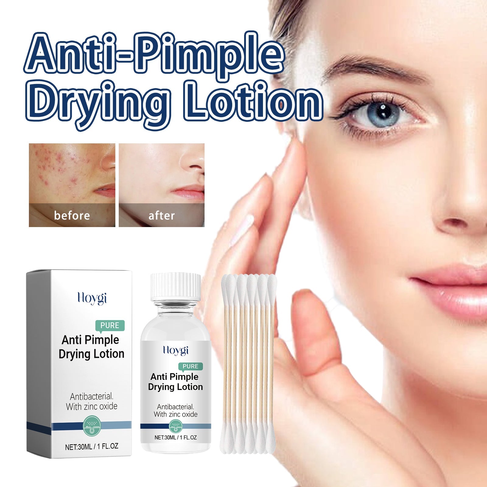 Anti-Pimple Drying Lotion, Facial Cleansing And Repair Lighten Acne Marks And Pits, Close Your Mouth And Mild Skin Cream