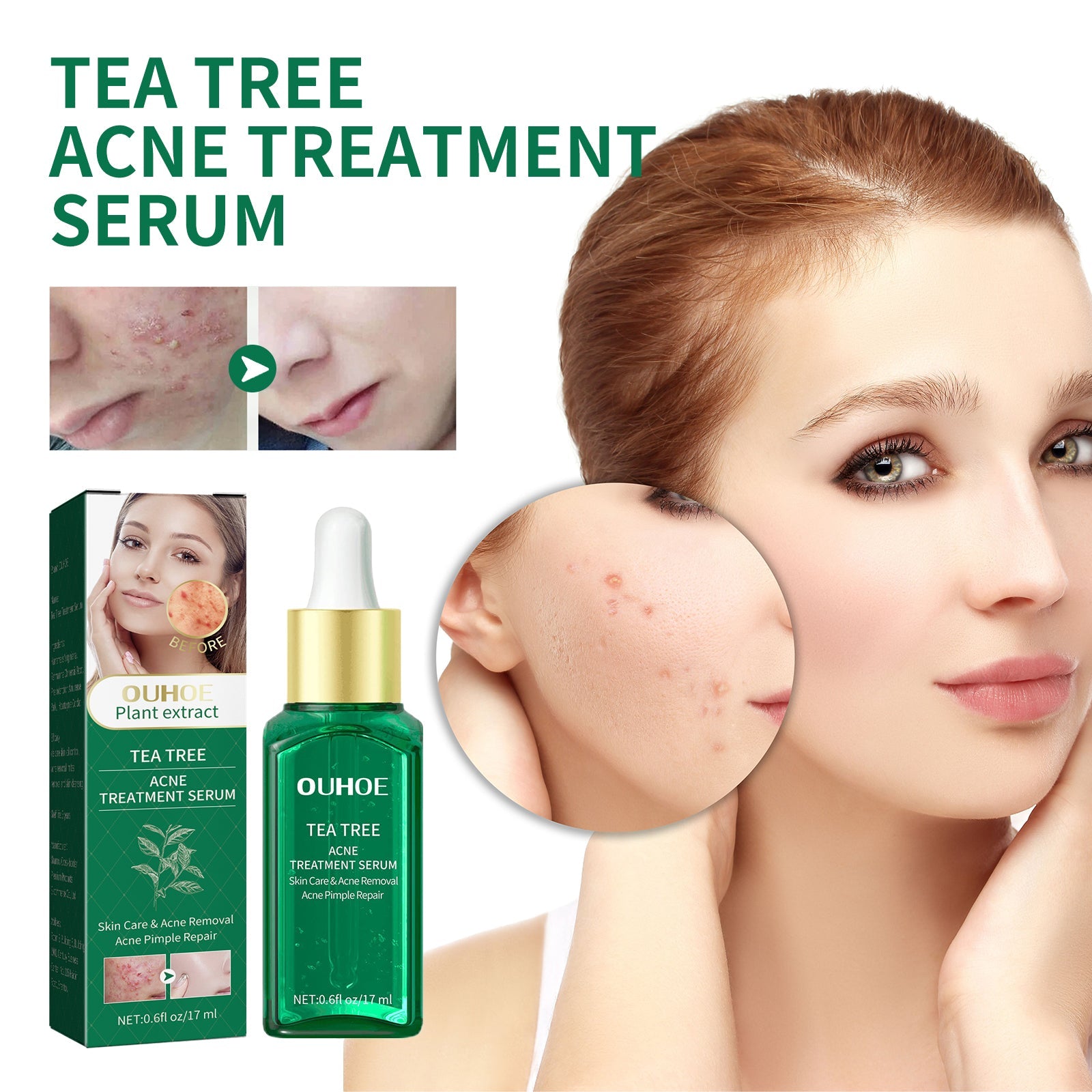 Tea Tree Oil Acne Serum, Remove Acne, Clear Acne, Repair Skin, Lighten Acne Printing Face Essence